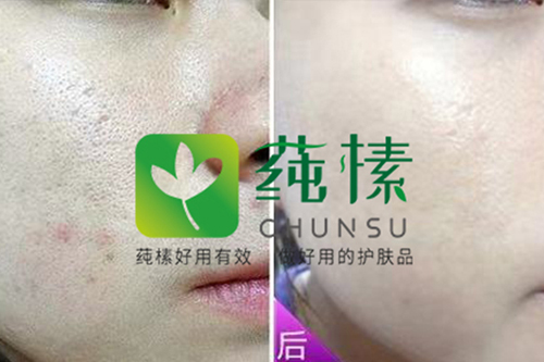 毛孔案例对比照